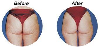 Weg cellulite